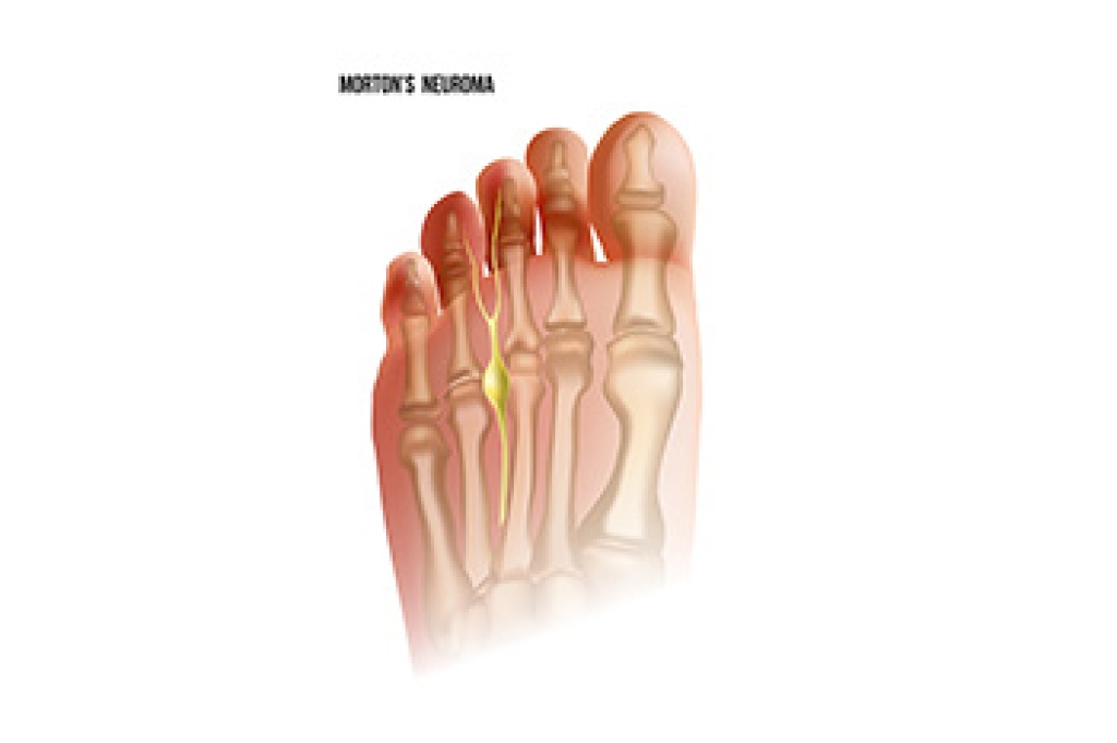 Burning Pain Between the Toes