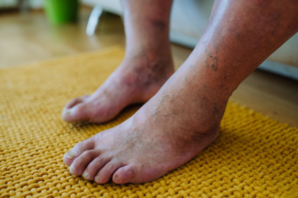Diabetic Foot Problems and Warning Signs