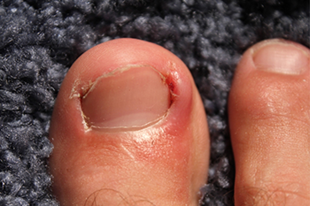 When Ingrown Toenails Become More Than a Nuisance