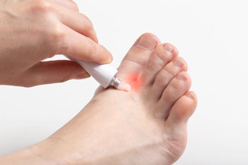 Athletes foot treatment in the Ocean County, NJ: Toms River (Brick Township, Jackson Township, Berkeley Township, Lacey Township, Ocean Township, Beachwood) areas