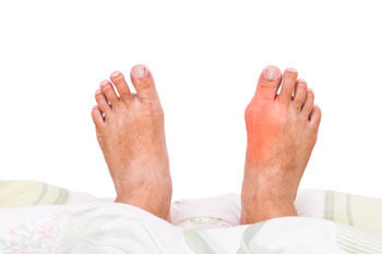 Bunions treatment in Ocean County, NJ: Toms River (Brick Township, Jackson Township, Berkeley Township, Lacey Township, Ocean Township, Beachwood) areas