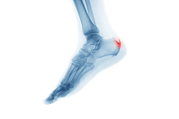 Heel spur treatment in the Ocean County, NJ: Toms River (Brick Township, Jackson Township, Berkeley Township, Lacey Township, Ocean Township, Beachwood) areas