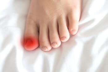 Ingrown toenail treatment in the Ocean County, NJ: Toms River (Brick Township, Jackson Township, Berkeley Township, Lacey Township, Ocean Township, Beachwood) areas