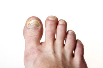 Toenail fungus treatment in the Ocean County, NJ: Toms River (Brick Township, Jackson Township, Berkeley Township, Lacey Township, Ocean Township, Beachwood) areas