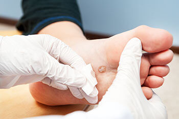 Warts treatment in the Ocean County, NJ: Toms River (Brick Township, Jackson Township, Berkeley Township, Lacey Township, Ocean Township, Beachwood) areas