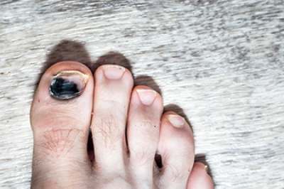 Causes and Symptoms of Runners Toenail