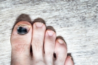 Causes and Symptoms of Runners Toenail