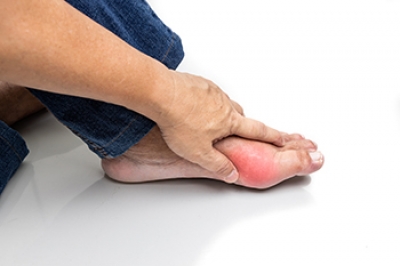 Understanding How to Live With Gout