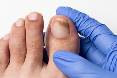 Definition and Causes of Toenail Fungus