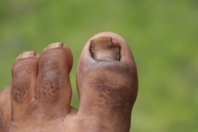 Managing and Preventing Toenail Fungus