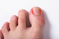 Ingrown Toenail Management