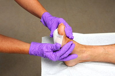 Alternative Treatment Options for Diabetic Foot Ulcers